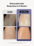 Laser Hair Removal For Women And Men